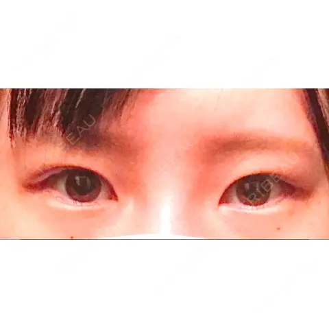 二重埋没 X CLINIC 恵比寿院 AFTER