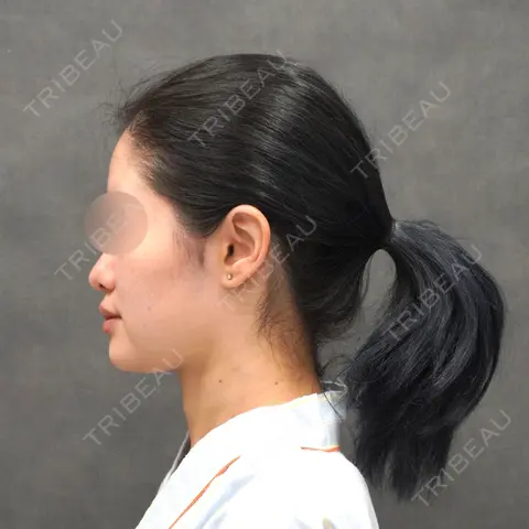 脂肪吸引（顔） / 脂肪注入（額） / 脂肪注入（輪郭） ヴェルトラクリニック 大阪院 AFTER
