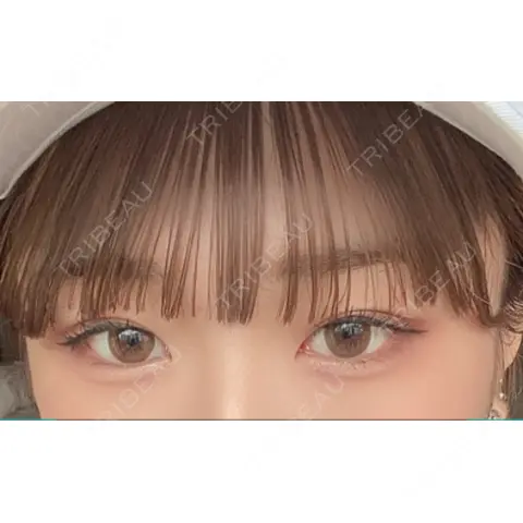 二重埋没 / 目尻切開 / 上まぶたの脂肪取り / タレ目形成・グラマラスライン（埋没） / ボトックス（タレ目） A CLINIC（エークリニック） 銀座院 AFTER