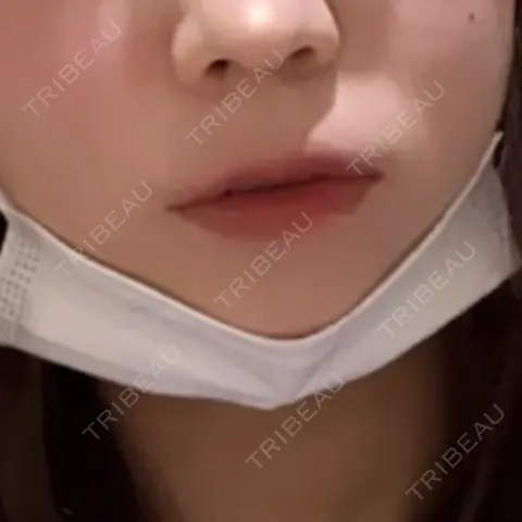 人中短縮 / ボトックス（口角） S-Laboクリニック 渋谷院 AFTER