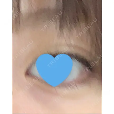 ヒアルロン酸注入（涙袋） アクトリー勝どきウェルネスメディカルクリニック AFTER