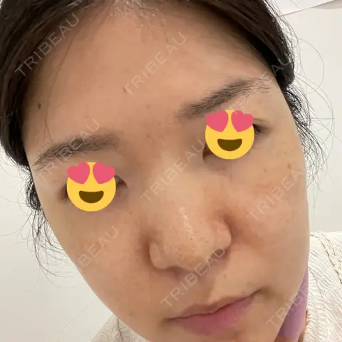 光治療（フォトフェイシャルなど） 椿クリニック 心斎橋院 AFTER
