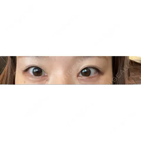 ヒアルロン酸注入（涙袋） ロレシー美容クリニック 心斎橋駅前院 AFTER