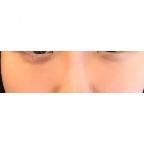 クマ治療 / 再生医療 / その他（肌） 湘南美容クリニック 渋谷院 AFTER