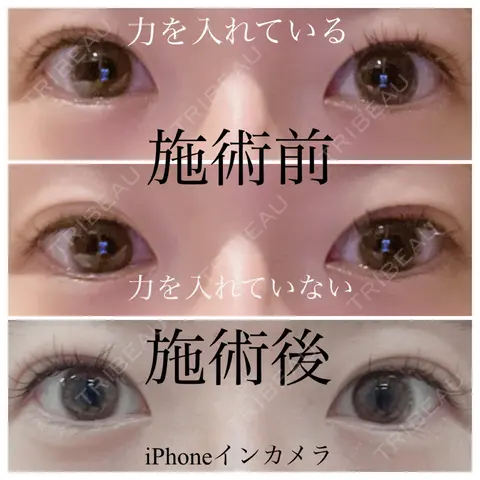 ハイフ（顔） ロナロナクリニック AFTER