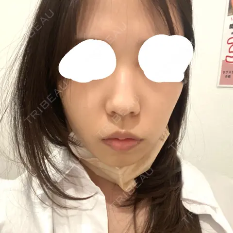 隆鼻術 / ヒアルロン酸注入（あご） / ボトックス（エラ・小顔） ASTRA BEAUTY CLINIC AFTER