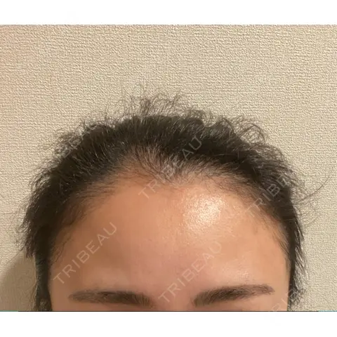 アートメイク（ヘアライン） トイトイトイクリニック 池袋院 AFTER