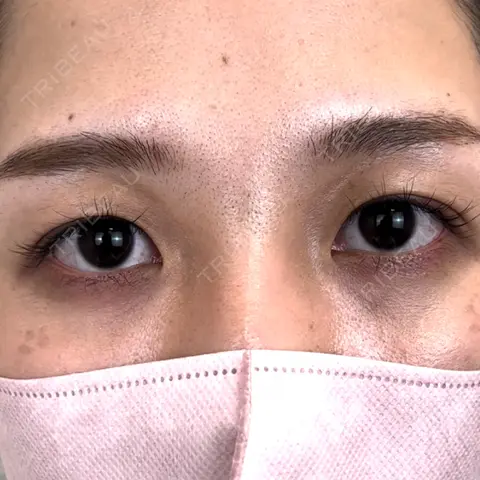 二重埋没 NARU Beauty Clinic 【ナルクリ】 AFTER