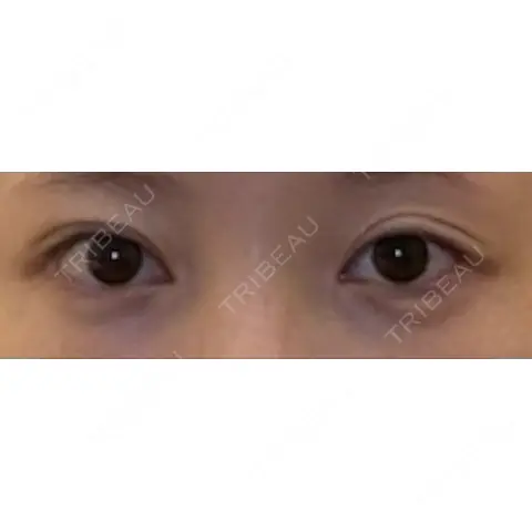 目尻切開 / タレ目形成・グラマラスライン（切開） JUN CLINIC AFTER