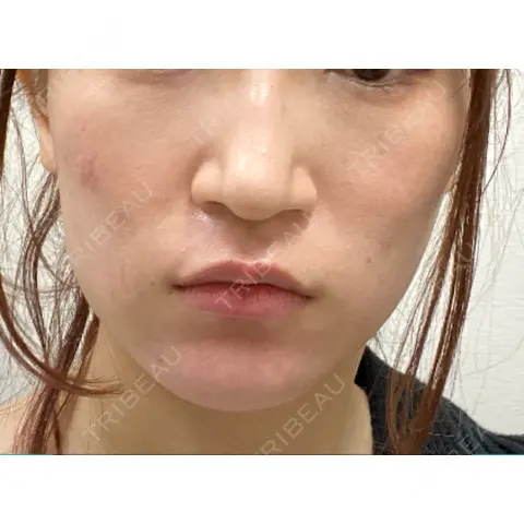 ボトックス（口角） / ボトックス（人中） S-Laboクリニック 渋谷院 AFTER