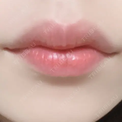 ボトックス（口角） / ボトックス（人中） S-Laboクリニック 渋谷院 AFTER