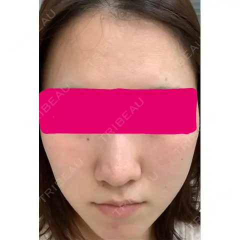 ダーマペン ルネッサンス美容外科医院 青山本院 AFTER