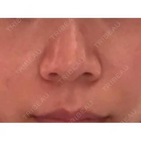 小鼻縮小（切開） 湘南美容クリニック 福岡院 AFTER