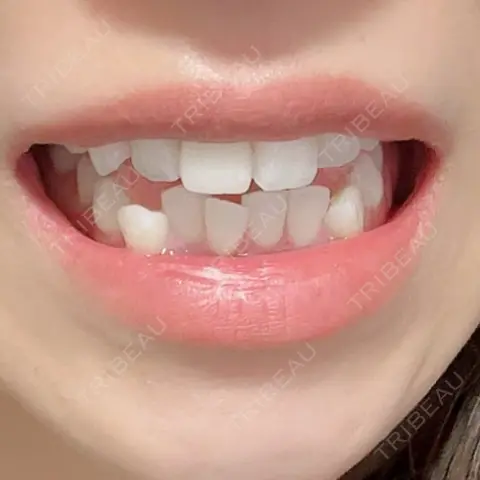 ホワイトニング U DENTAL OFFICE 恵比寿 BEFORE