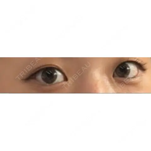 その他（目元） いちのせ形成外科・皮膚科 眼瞼＆フェイスクリニック AFTER