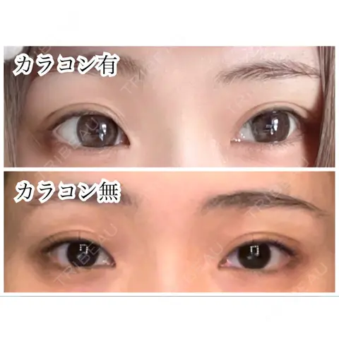 二重埋没 / 目頭切開 HAAB×DREAM BEAUTY CLINIC 東京本院 BEFORE