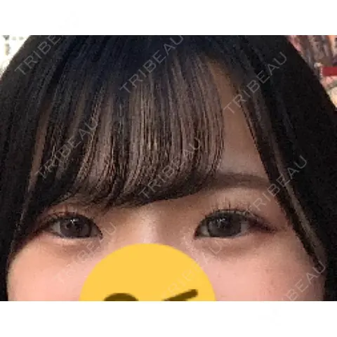 ヒアルロン酸注入（涙袋） AI Beauty Clinic （エーアイ美容クリニック） BEFORE