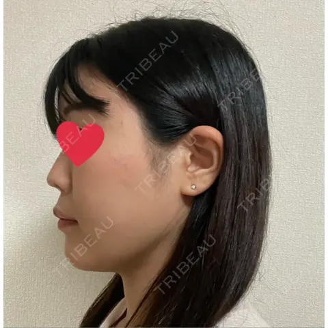 ハイフ（顔） ルネッサンス美容外科医院 青山本院 AFTER