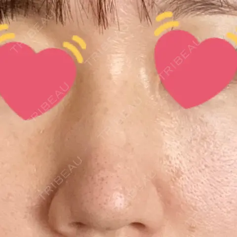 軟骨移植 フェアクリニック川口 AFTER