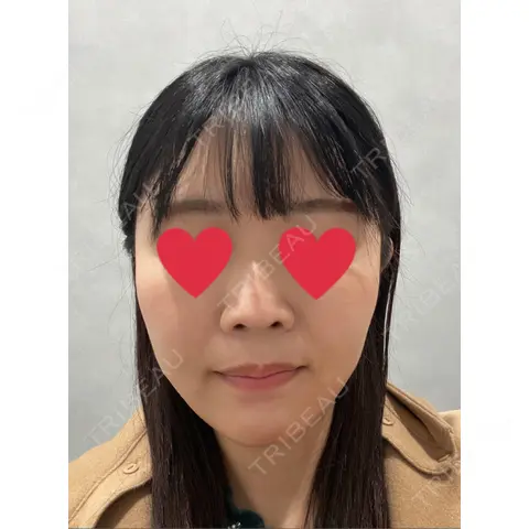 小鼻縮小（非切開） T CLINIC 新宿院 AFTER