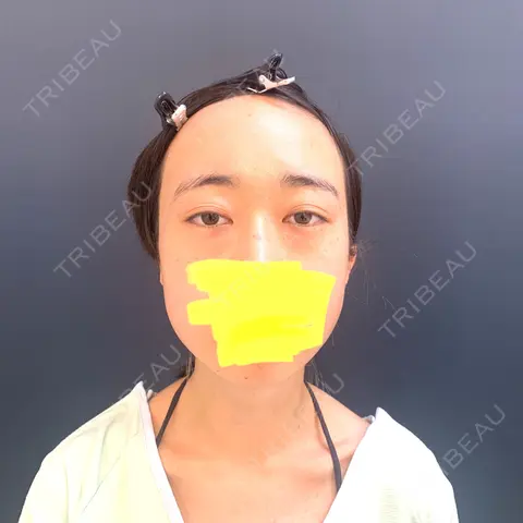 下まぶたたるみ取り / ヒアルロン酸注入（あご） / ボトックス（エラ・小顔） コスメディカルクリニック シンシア 銀座院 AFTER