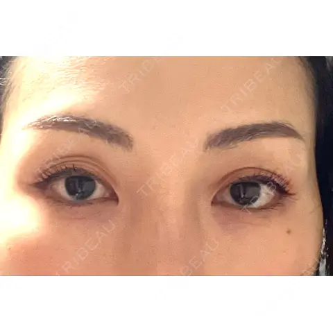 二重埋没 / 眼瞼下垂（非切開） フェアクリニック川口 AFTER