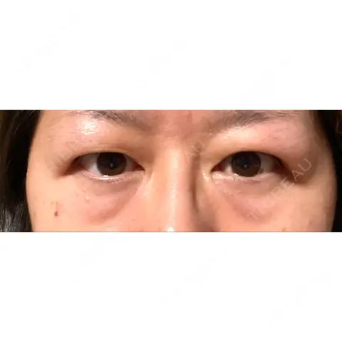 二重切開 / クマ治療 / 上まぶたの脂肪取り / 下まぶたの脂肪取り / その他（目元） ながしまクリニック AFTER