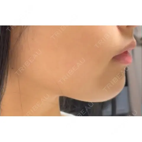 脂肪溶解注射（顔） あいち栄クリニック AFTER