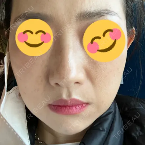 ピーリング（ニキビ・毛穴） / 毛穴洗浄（ハイドラフェイシャルなど） KARIS beauty clinic AFTER