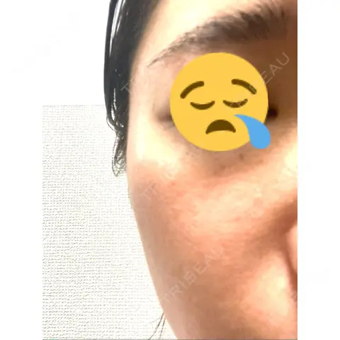 シミ取りレーザー / ピコレーザートーニング（美白・肝斑） Olino美容外科・美容皮膚科 AFTER