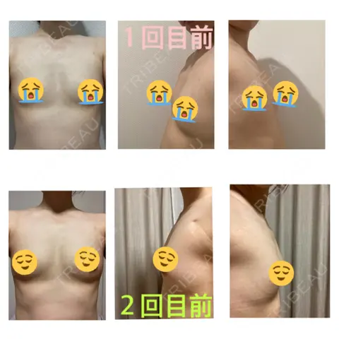 豊胸（脂肪注入） 銀座マイアミ美容外科 BEFORE