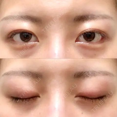二重切開 ルネッサンス美容外科医院 青山本院 AFTER