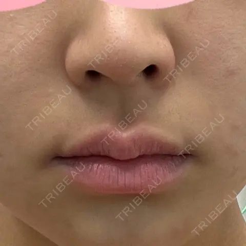 人中短縮 聖心美容クリニック 六本木院 AFTER