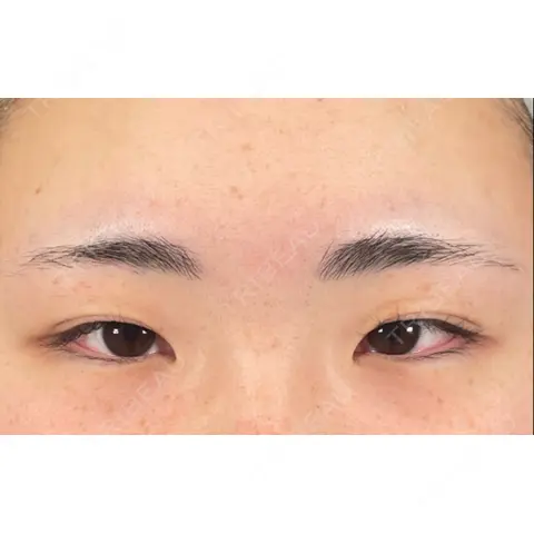 二重埋没 アリエル美容クリニック 郡山院 AFTER