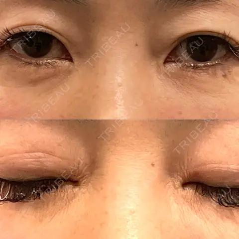 二重埋没 アリエル美容クリニック 郡山院 AFTER