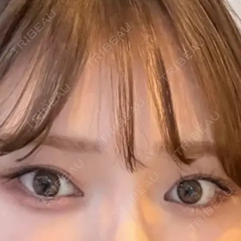 二重埋没 HAAB×DREAM BEAUTY CLINIC 東京本院 AFTER