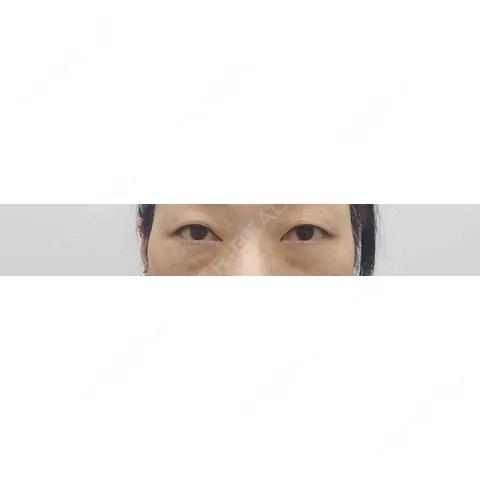 二重埋没 アリエル美容クリニック 郡山院 AFTER