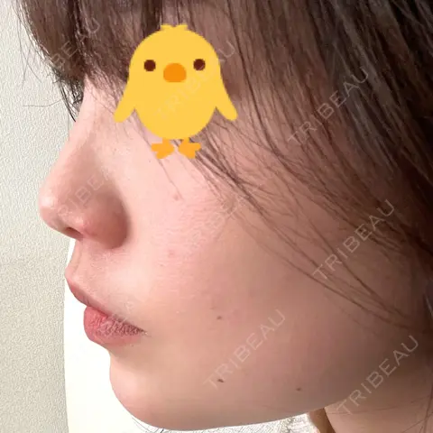 ヒアルロン酸注入（鼻） / ヒアルロン酸注入（あご） 東京形成美容外科 船橋院 AFTER