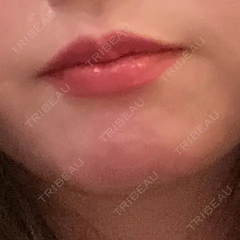 ヒアルロン酸注入（涙袋） / ヒアルロン酸注入（唇） 東京シンデレラ美容外科 池袋院 AFTER