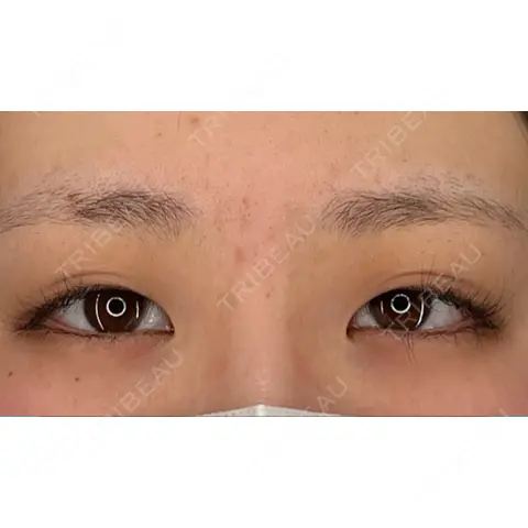 二重埋没 / ヒアルロン酸注入（涙袋） HAAB×DREAM BEAUTY CLINIC 大阪梅田院 AFTER