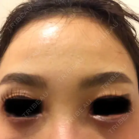 ヒアルロン酸注入（涙袋） AI Beauty Clinic （エーアイ美容クリニック） BEFORE