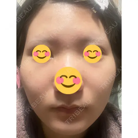 ボトックス（エラ・小顔） AI Beauty Clinic （エーアイ美容クリニック） BEFORE