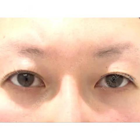 二重埋没 EMMA CLINIC（エマクリニック） BEFORE