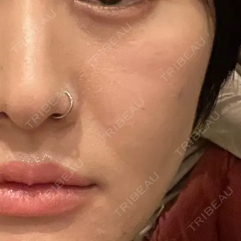 ヒアルロン酸注入（頬） Kalon Clinic AFTER