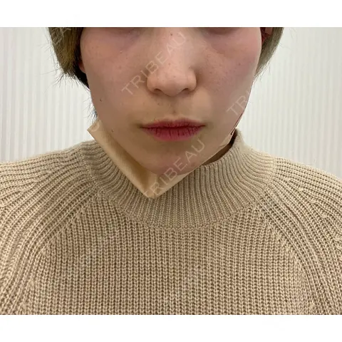 ボトックス（エラ・小顔） / ハイフ（顔） TCB東京中央美容外科 熊本院 AFTER