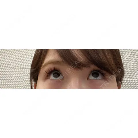 二重埋没 / クマ治療 お茶の水美容形成クリニック AFTER