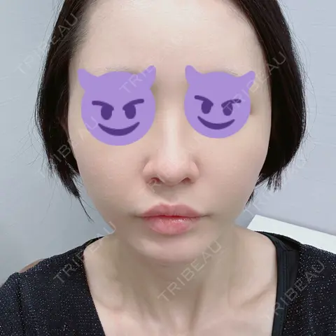 糸リフト EMMO FACE CLINIC 大宮院 AFTER