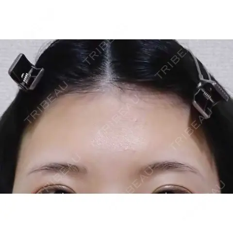 脂肪吸引（脚） / 脂肪注入（額） 藤・ナチュレ美容クリニック 銀座院 AFTER