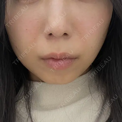 糸リフト / ボトックス（エラ・小顔） / ヒアルロン酸注入（頬） TCB東京中央美容外科 銀座有楽町院 AFTER