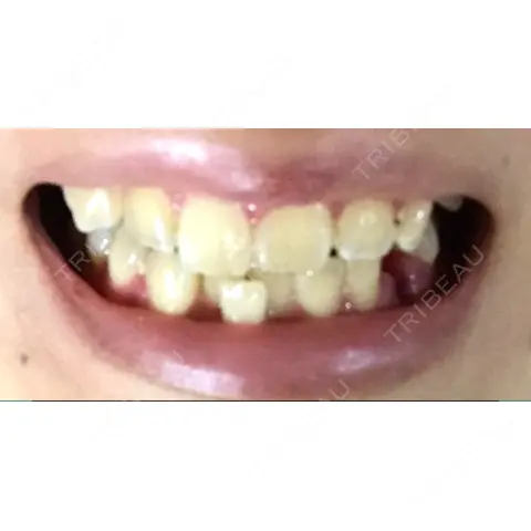矯正（ワイヤー） 総合歯科HMクリニック大阪中央 AFTER